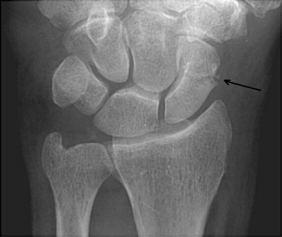 File:Carpal Fracture.jpg