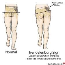 Pathologic Gait Patterns | Orthopedia Wiki | Fandom