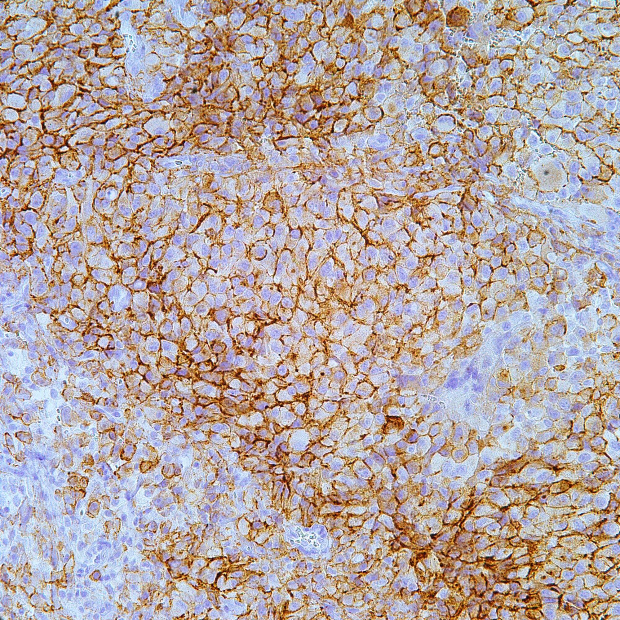 Epithelial Membrane Antigen EMA Pathology Resident Wiki Fandom epithelial-membrane-antigen-ema-pathology-resident-wiki-fandom