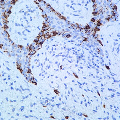 Image - CD117.melanocytes.400x.basic.jpg | Pathology Resident Wiki