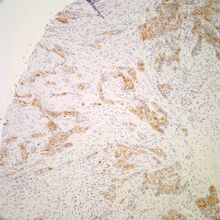 Hbme 1 Pathology Resident Wiki Fandom