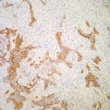 Hbme 1 Pathology Resident Wiki Fandom