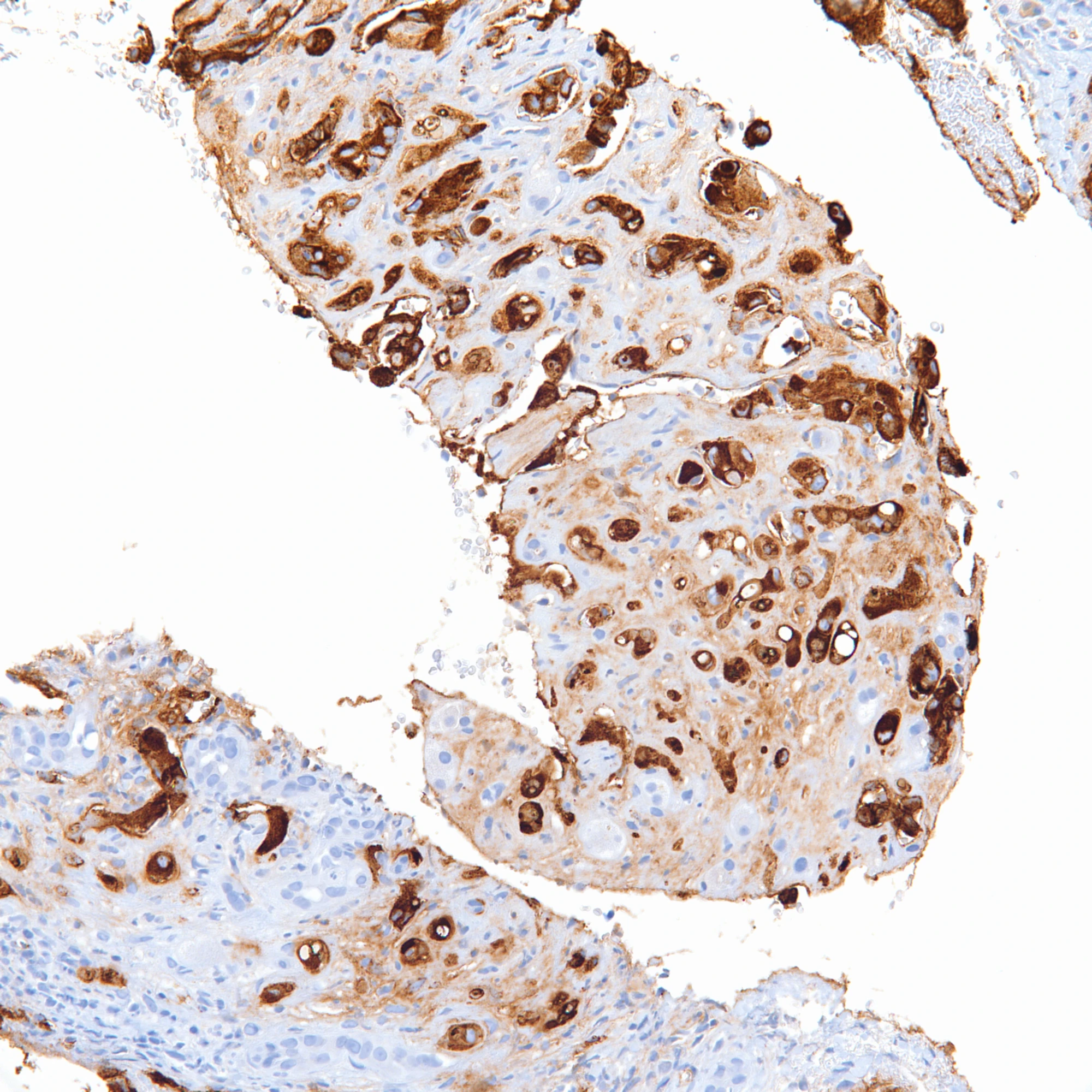 Factor VIII Related Antigen (von Willebrand Factor) Pathology
