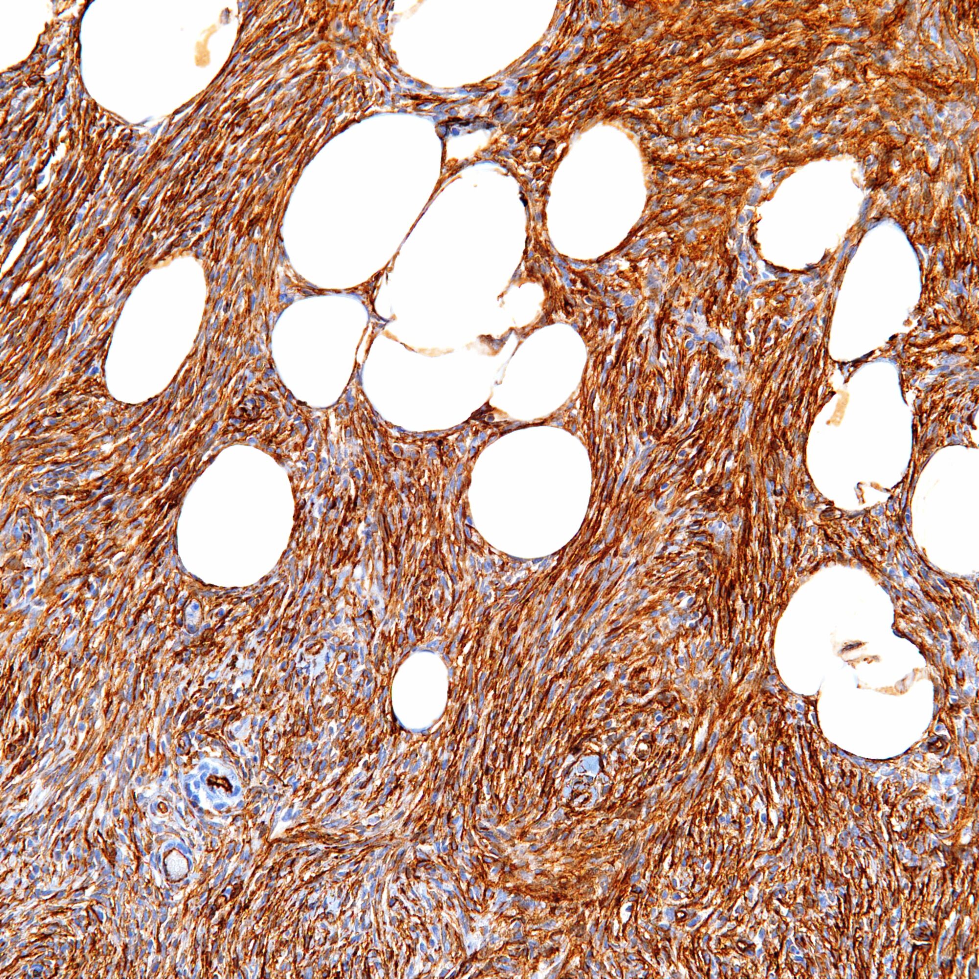 image-cd34-dfsp-200x-jpg-pathology-resident-wiki-fandom-powered