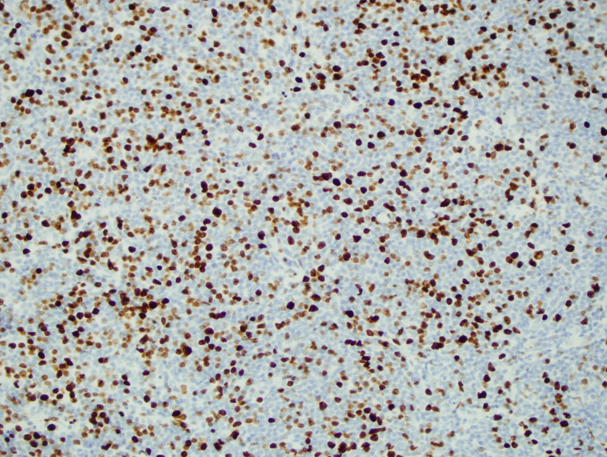 Ki-67 (MIB-1) | Pathology Resident Wiki | Fandom