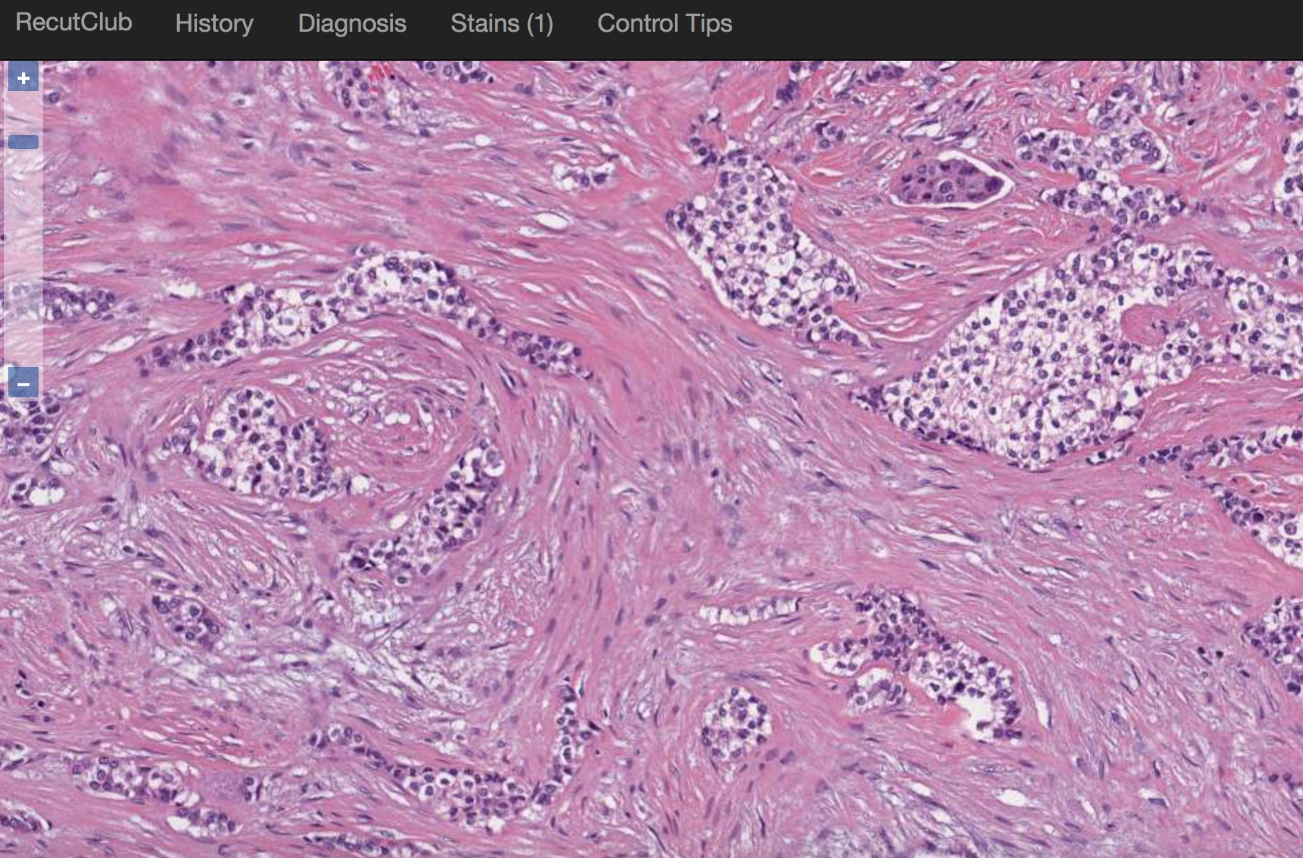 Hyalinizing Clear Cell Carcinoma of Lung Whole Slide