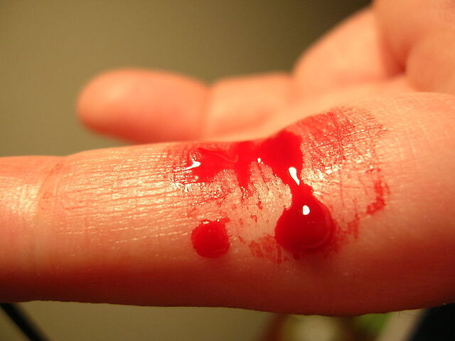 File:Bleeding finger.jpeg