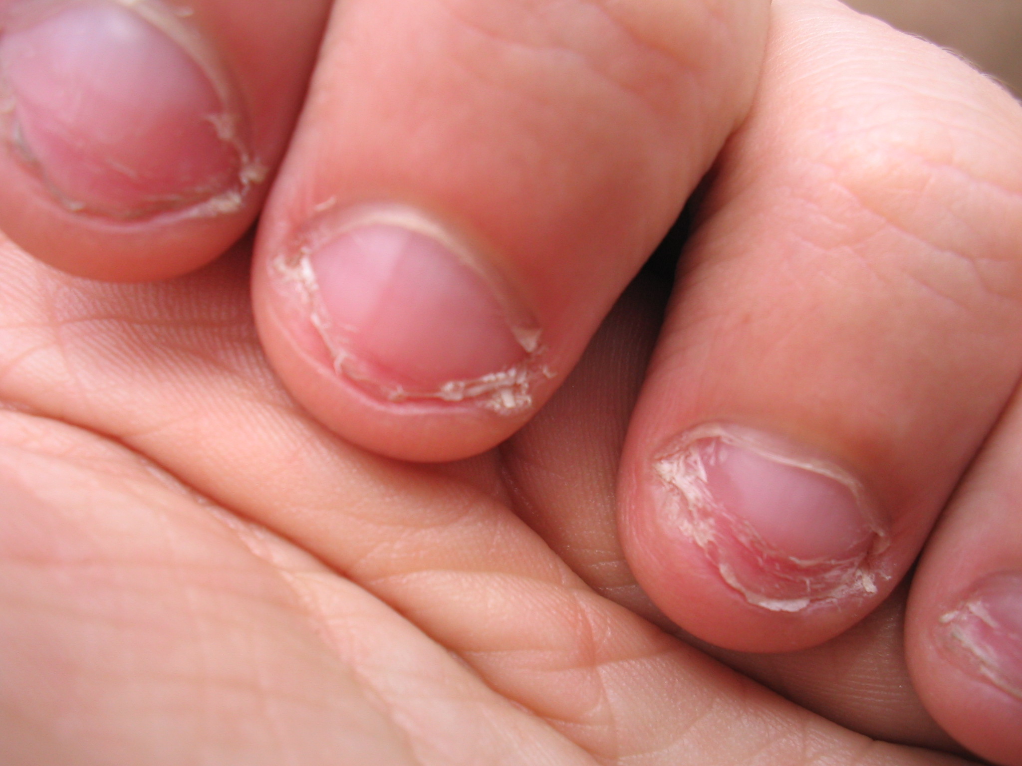 Nail Biters How To Break The Embarrassing Habit Of Biting Your Nails English Edition Book Pdf Free