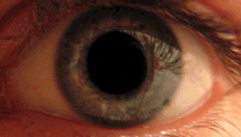 Does valium cause pupil dilation