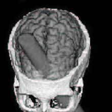 Phineas Gage Psychology Wiki Fandom