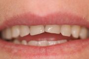 Reverse-smile-line-before