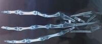 Cusco hand x ray