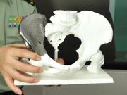 Prostheses-3d-printed-4