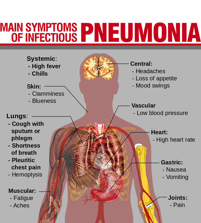 Image Pneumonia.jpg Diseases and Their Cures Wikia FANDOM powered