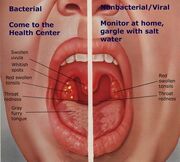 Tonsillitis-1-