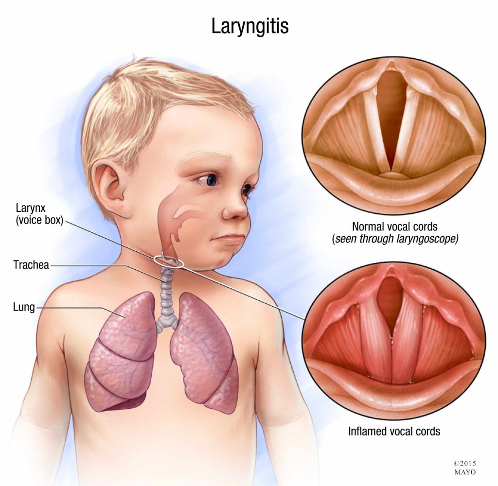 laryngitis-diseases-and-their-cures-wikia-fandom-powered-by-wikia