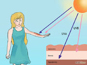 Sunburn