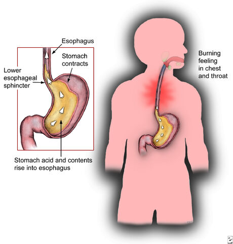 File:Heartburn-prognosis.jpg