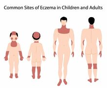 Eczema-areas-500x410