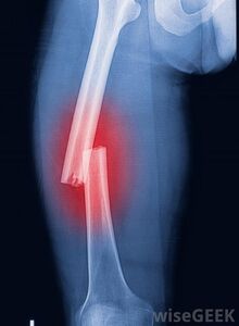 X-ray-of-broken-thigh-bone