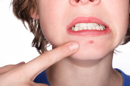 Teen with acne