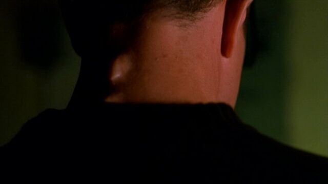 File:Knowle Rohrer's neck deformity.jpg