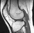 Mri of knee